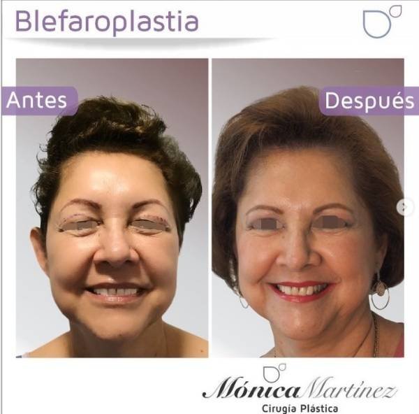 via-cirujanamonicamartinez-katrix-katrix via cirujanamonicamartinez katrix