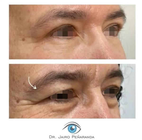 via-drjairopenaranda-katrix-katrix via drjairopenaranda katrix