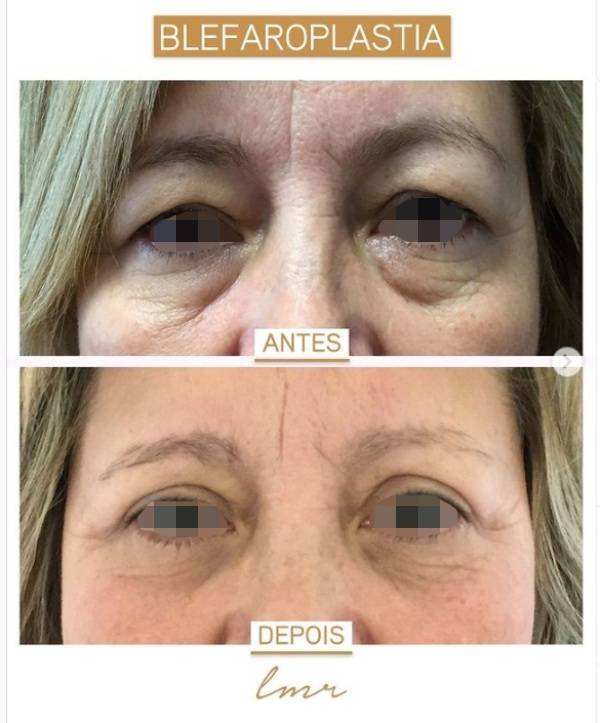 via-lmrcirurgiaplastica-pt-2-katrix-katrix via lmrcirurgiaplastica pt 2 katrix