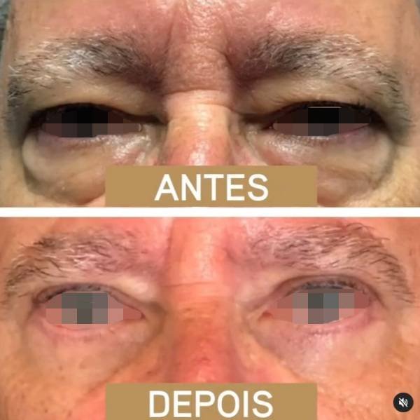 via-lmrcirurgiaplastica-pt-3-katrix-katrix via lmrcirurgiaplastica pt 3 katrix