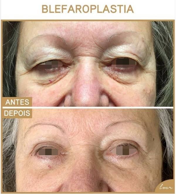 via-lmrcirurgiaplastica-pt-4-katrix-katrix via lmrcirurgiaplastica pt 4 katrix