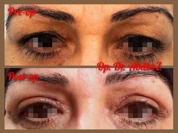 via-op-dr_-abdullah-bozan-katrix-katrix via op dr abdullah bozan katrix