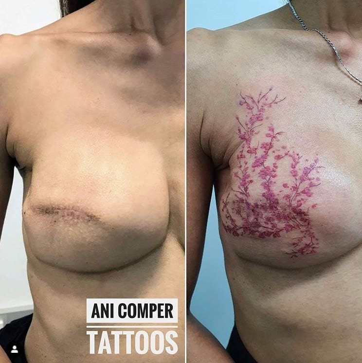 Tatuagem de flor de cerejeira no lugar do bico do peito e cicatriz de cirurgia mastectomia